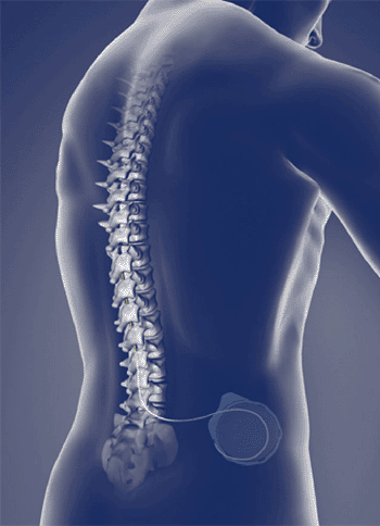 Imagen: La bomba de medicamentos Prometra implantada cerca del área intratecal (Fotografía cortesía de Medasys).